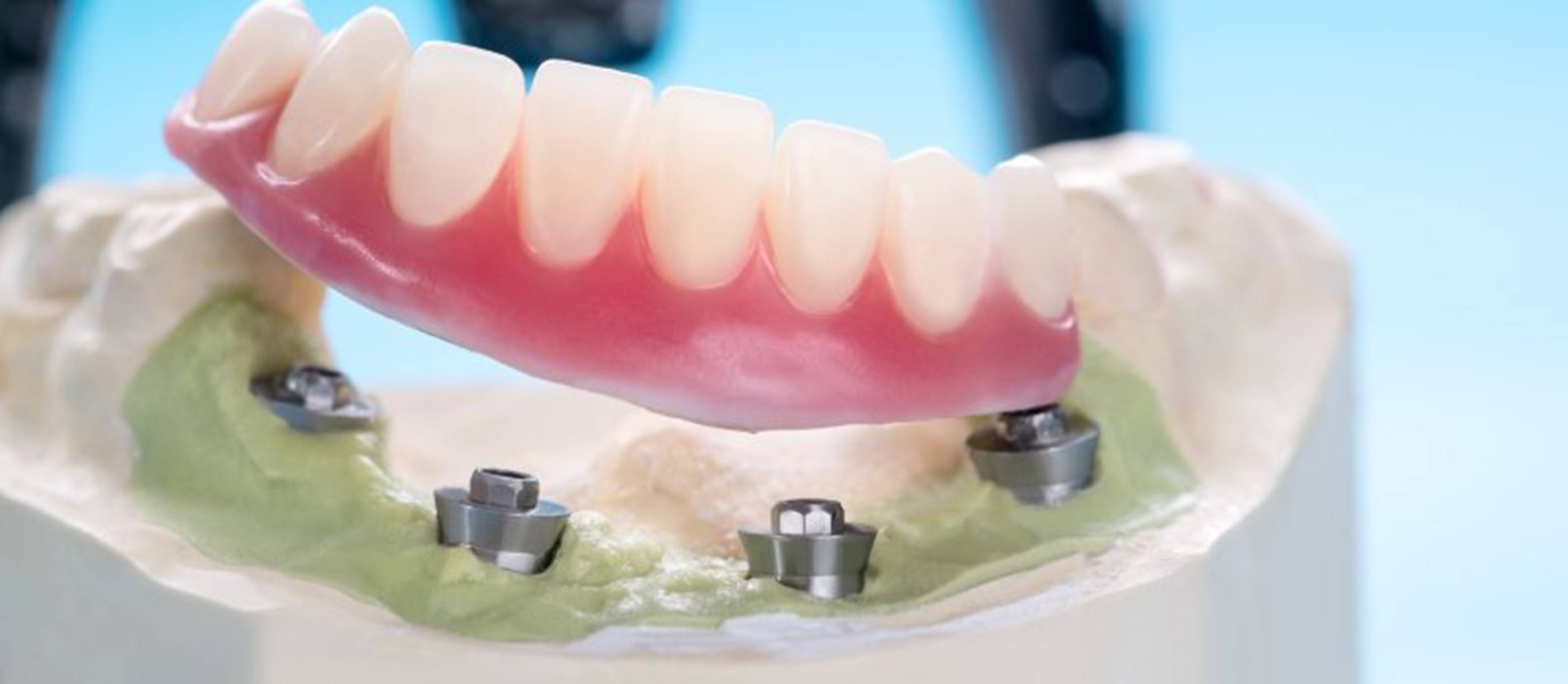 Denture sitting on top of a wax implant model 