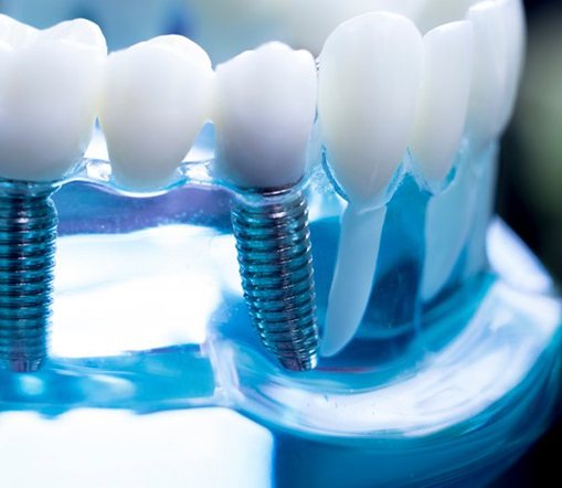 Close up of a resin model that shows dental implant posts