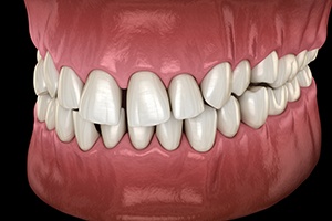 Illustration of gapped teeth