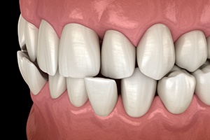 Illustration of a crossbite