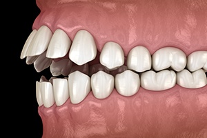 Illustration of an open bite