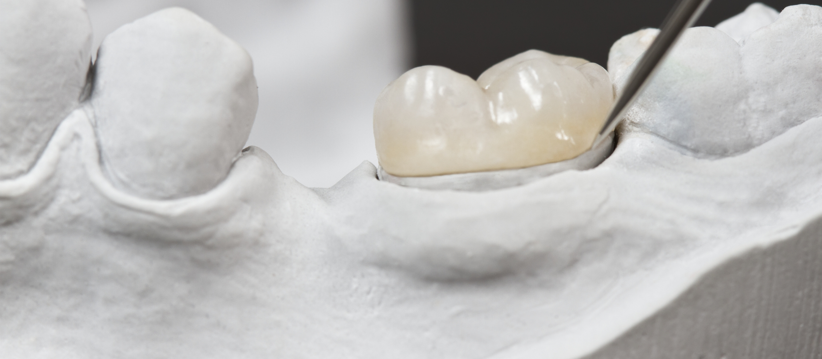 Dental crown covering a tooth in a model of the mouth